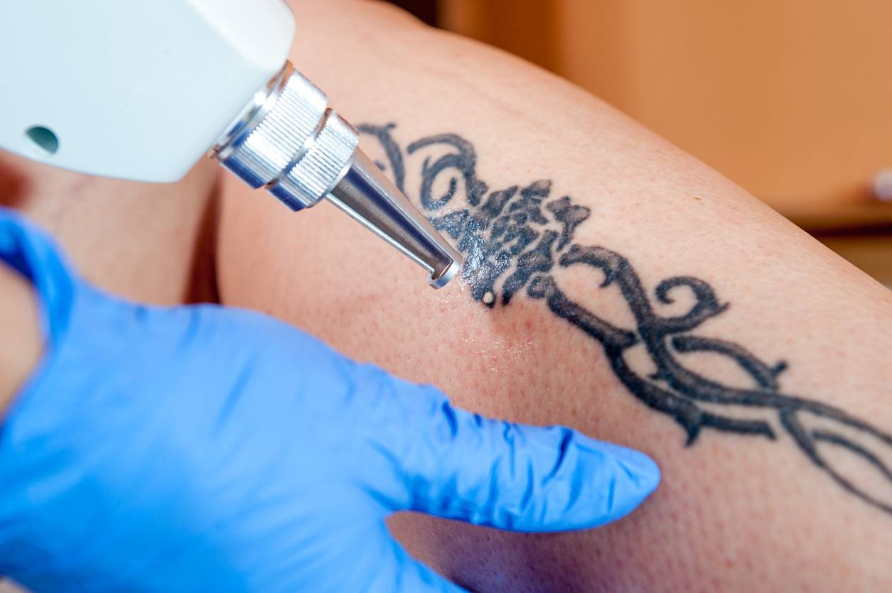 tattoo removal session process