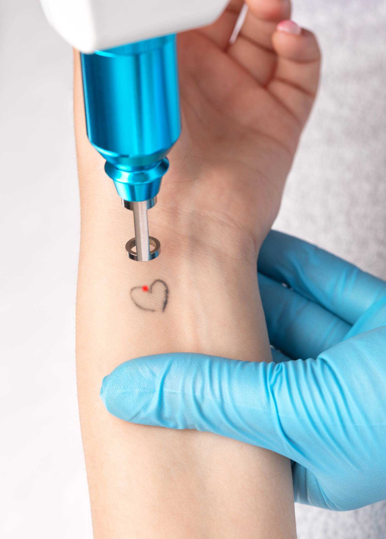 laser tattoo removal techniques